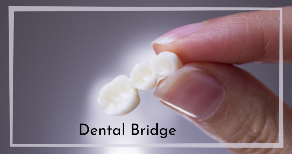 Dental Bridge
